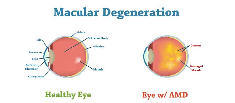 macular dystrophy