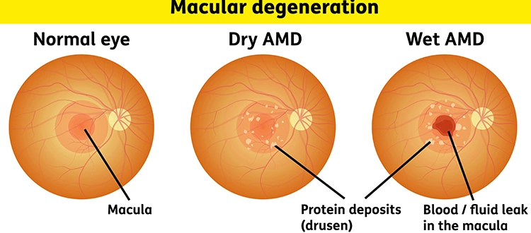 macular-degeneration-