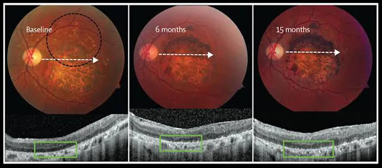 stargardts disease